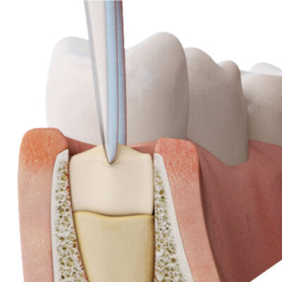PRGF – ENDORET®, product image