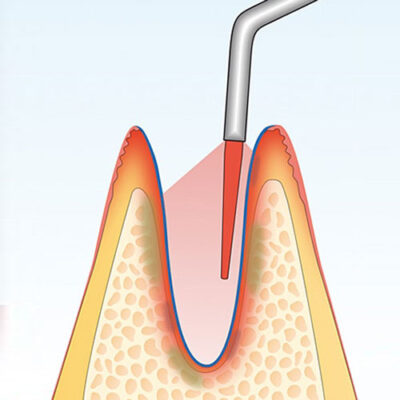 HELBO Laser Therapy System, product image